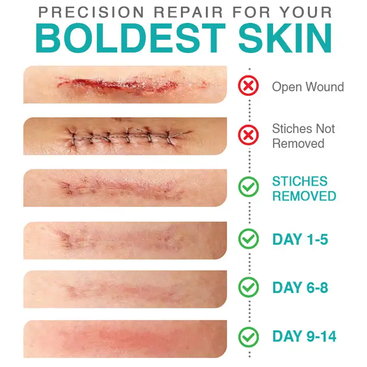 𝗖𝗮𝗿𝗲𝗕𝗿𝗲𝗲𝘇𝗲® 3 az 1-ben mikrotűs ápoló tapasz - Image 4