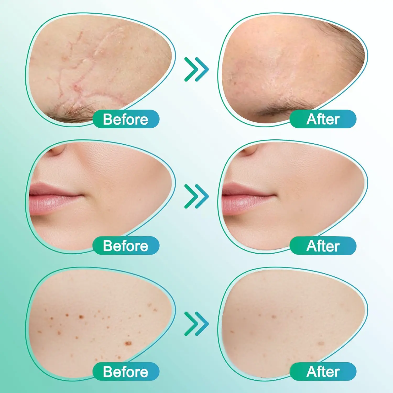 𝗖𝗮𝗿𝗲𝗕𝗿𝗲𝗲𝘇𝗲® 3 az 1-ben mikrotűs ápoló tapasz - Image 5