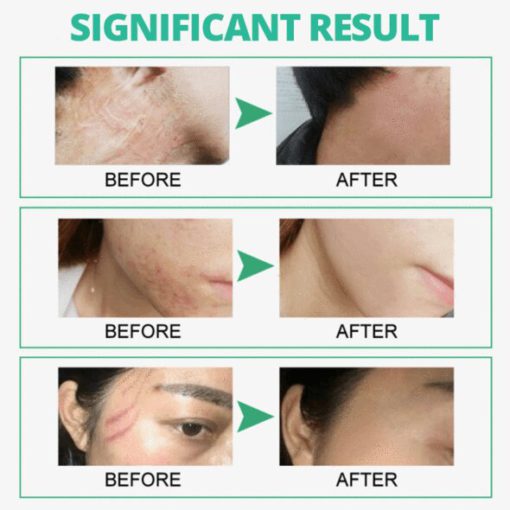 Skin Rebound Scarless krém - Image 6
