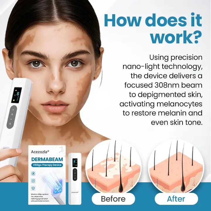 Acezozla® DermaBeam Vitiligo terápiás készülék - Image 3