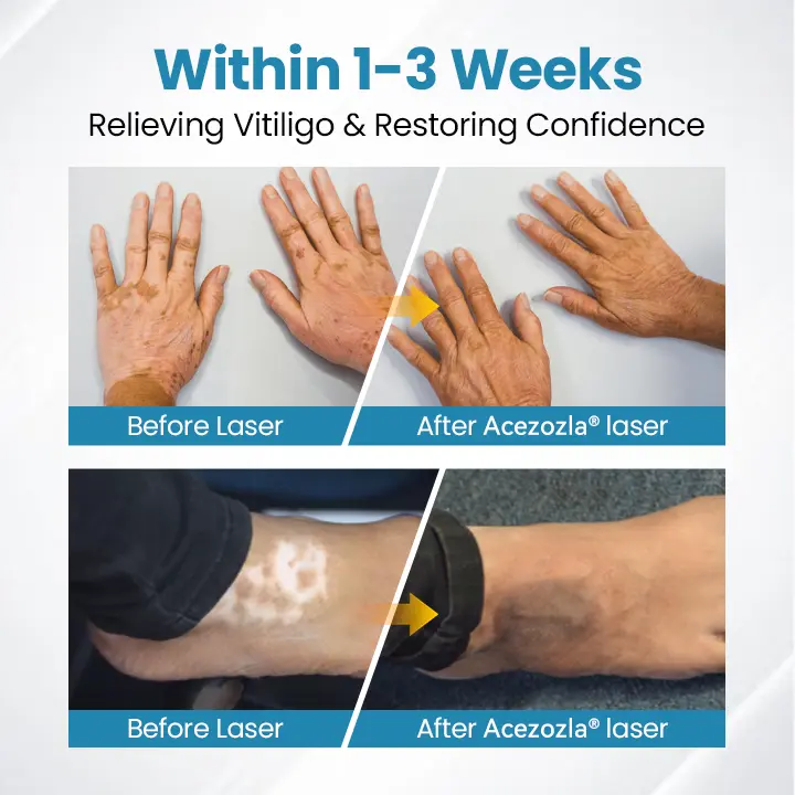 Acezozla® DermaBeam Vitiligo terápiás készülék - Image 4