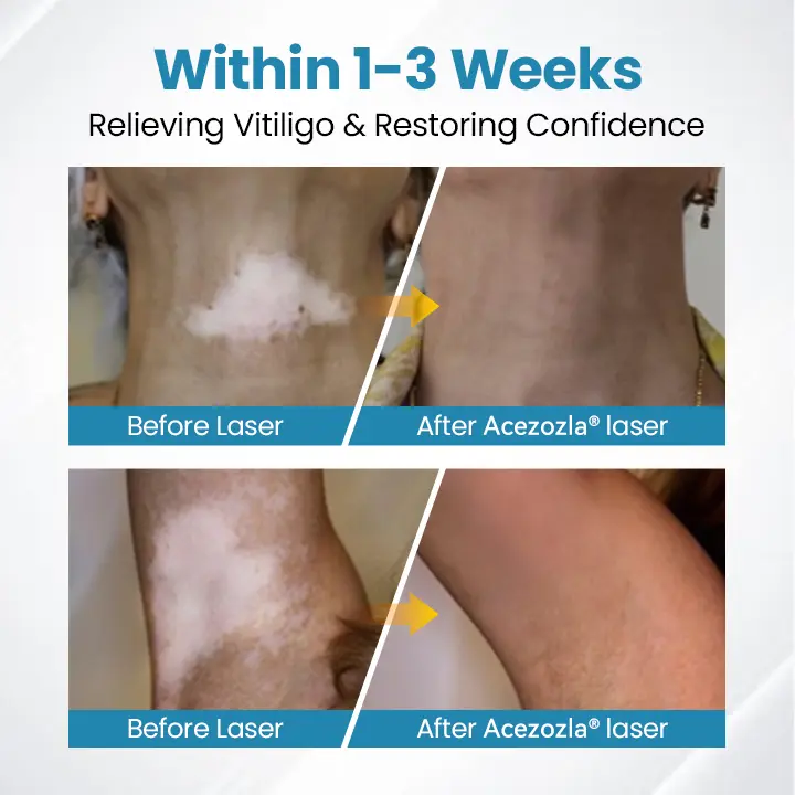 Acezozla® DermaBeam Vitiligo terápiás készülék - Image 5