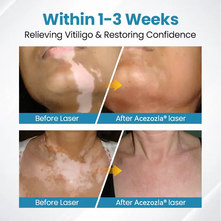 Acezozla® DermaBeam Vitiligo terápiás készülék - Image 7